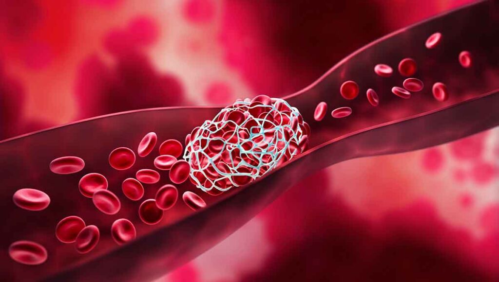 Die Thrombose: Ein Blutgerinnsel verstopft eine Vene und sorgt für einen Blutstau.