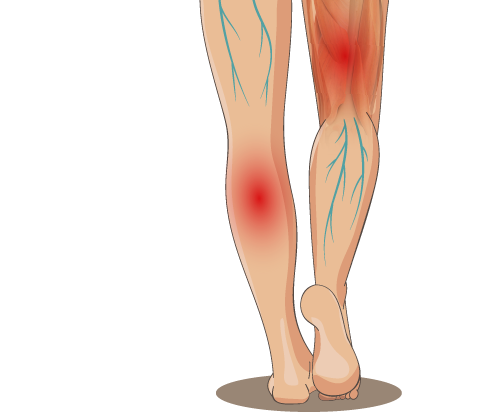 Symptome einer Thrombose: blau hervortretende Adern, Spannungsschmerzen, geschwollene und erwärmte Beine, Schweregefühl